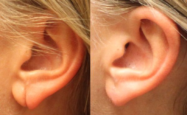 Earlobe Repair Surgery